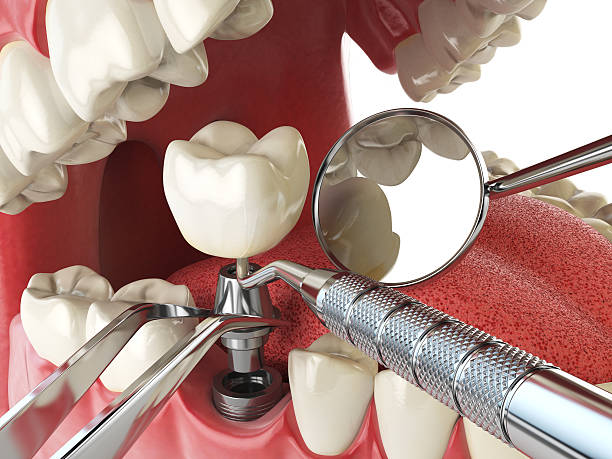 Best Chipped Tooth Repair Near Me  in Cherryville, PA